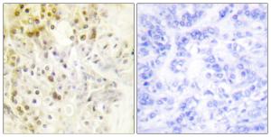 Immunohistochemical analysis of paraffin-embedded human breast carcinoma tissue using Anti-Cyclin L1 Antibody. The right hand panel represents a negative control, where the antibody was pre-incubated with the immunising peptide.