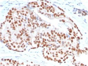 Immunohistochemical analysis of formalin-fixed, paraffin-embedded human prostate carcinoma using Anti-NKX31 Antibody [NKX31/3347]