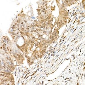 Immunohistochemistry analysis of paraffin-embedded human colon carcinoma tissue using Anti-TAZ Antibody (A306094) at a dilution of 1:50 (40x lens). Perform high pressure antigen retrieval with 10 mM citrate buffer pH 6.0 before commencing with IHC staining protocol.