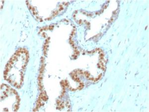 Immunohistochemical analysis of formalin-fixed, paraffin-embedded human prostate carcinoma using Anti-NKX31 Antibody [NKX31/3347]