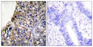 Immunohistochemical analysis of paraffin-embedded human lung carcinoma tissue using Anti-Claudin 7 Antibody. The right hand panel represents a negative control, where the Antibody was pre-incubated with the immunising peptide