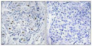 Immunohistochemical analysis of paraffin-embedded human breast cancer using Anti-HXK1 Antibody 1:100 (4 °C overnight). The right hand panel represents a negative control, where the Antibody was pre-incubated with the immunising peptide