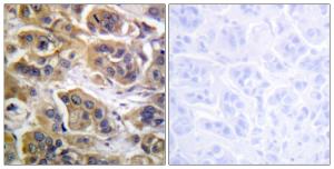 Immunohistochemical analysis of paraffin-embedded human breast carcinoma tissue using Anti-HER3 Antibody. The right hand panel represents a negative control, where the antibody was pre-incubated with the immunising peptide