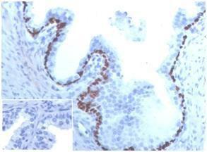 Immunohistochemical analysis of formalin-fixed, paraffin-embedded human prostate cancer tissue using Anti-p63 Antibody [TP63/4379R] Inset: PBS instead of the primary antibody Secondary antibody negative control