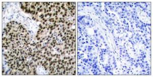 Immunohistochemical analysis of paraffin-embedded human breast carcinoma tissue using Anti-HSF1 Antibody. The right hand panel represents a negative control, where the antibody was pre-incubated with the immunising peptide