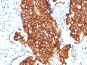 Immunohistochemical analysis of formalin-fixed, paraffin-embedded human breast carcinoma using Anti-HER2 Antibody [ERBB2/4439]