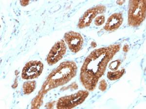 Immunohistochemical analysis of formalin-fixed, paraffin-embedded human breast carcinoma using Anti-HER4 Antibody [ERBB4/2581]