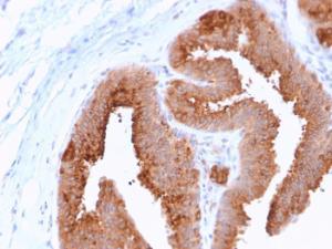 Immunohistochemical analysis of formalin-fixed, paraffin-embedded human breast carcinoma using Anti-HER4 Antibody [ERBB4/2581]