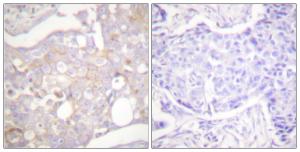 Immunohistochemical analysis of paraffin-embedded human breast carcinoma tissue using Anti-Claudin 4 Antibody The right hand panel represents a negative control, where the antibody was pre-incubated with the immunising peptide