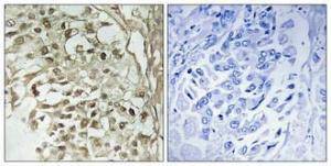 Immunohistochemical analysis of paraffin-embedded human breast cancer using Anti-DBF4 Antibody 1:100 (4°C overnight). The right hand panel represents a negative control, where the antibody was pre-incubated with the immunising peptide.