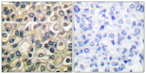 Immunohistochemical analysis of paraffin-embedded human breast carcinoma tissue using Anti-Claudin 1 Antibody. The right hand panel represents a negative control, where the antibody was pre-incubated with the immunising peptide