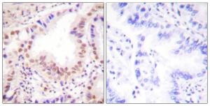 Immunohistochemical analysis of paraffin-embedded human lung carcinoma tissue using Anti-ETS1 Antibody. The right hand panel represents a negative control, where the antibody was pre-incubated with the immunising peptide.