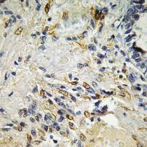 Immunohistochemical analysis of paraffin-embedded human breast cancer using Anti-ETS1 Antibody