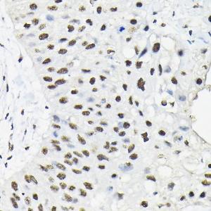 Immunohistochemistry analysis of paraffin-embedded human lung cancer using Anti-HNRNPA3 Antibody (A309027) at a dilution of 1:100 (40X lens). Perform high pressure antigen retrieval with 10 mM citrate buffer pH 6.0 before commencing with IHC staining protocol