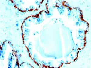 Immunohistochemical analysis of formalin-fixed, paraffin-embedded human prostate carcinoma using Anti-Basic Cytokeratin Antibody [SPM591]