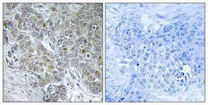 Immunohistochemical analysis of paraffin-embedded human breast cancer using Anti-CDK8 Antibody 1:100 (4 °C overnight). The right hand panel represents a negative control, where the Antibody was pre-incubated with the immunising peptide