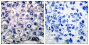 Immunohistochemical analysis of paraffin-embedded human breast carcinoma tissue using Anti-EGFR Antibody. The right hand panel represents a negative control, where the antibody was pre-incubated with the immunising peptide.