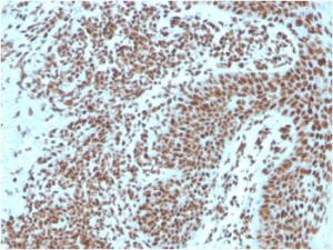 Immunohistochemical analysis of formalin-fixed, paraffin-embedded human basal cell carcinoma using Anti-Nucleophosmin Antibody [NPM1/3287]