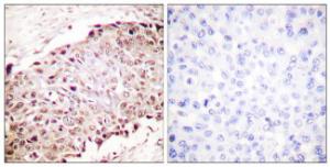 Immunohistochemical analysis of paraffin-embedded human breast carcinoma tissue using Anti-Sumo1 Antibody. The right hand panel represents a negative control, where the Antibody was pre-incubated with the immunising peptide