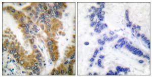 Immunohistochemical analysis of paraffin-embedded human lung carcinoma tissue using Anti-CrkL Antibody. The right hand panel represents a negative control, where the antibody was pre-incubated with the immunising peptide.