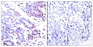 Immunohistochemical analysis of paraffin-embedded human breast carcinoma tissue using Anti-STAT1 Antibody. The right hand panel represents a negative control, where the antibody was pre-incubated with the immunising peptide