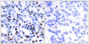 Immunohistochemical analysis of paraffin-embedded human breast carcinoma tissue using Anti-JunB Antibody. The right hand panel represents a negative control, where the antibody was pre-incubated with the immunising peptide