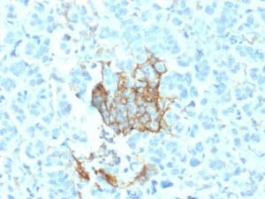 Immunohistochemical analysis of formalin-fixed, paraffin-embedded human breast carcinoma using Anti-p75 NGF Receptor Antibody [NGFR/1964]