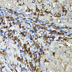 Immunohistochemistry analysis of paraffin-embedded human liver cancer using Anti-MHC Class II beta Antibody (A306106) at a dilution of 1:100 (40X lens). Perform high pressure antigen retrieval with 10 mM citrate buffer pH 6.0 before commencing with IHC staining protocol