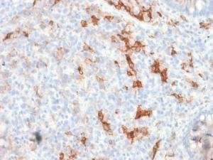 Immunohistochemical analysis of formalin-fixed, paraffin-embedded human melanoma using Anti-p75 NGF Receptor Antibody [NGFR/1997R]