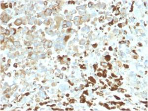 Immunohistochemical analysis of formalin-fixed, paraffin-embedded human melanoma using Anti-p75 NGF Receptor Antibody [NGFR/2550R]