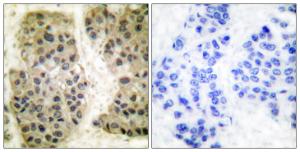 Immunohistochemical analysis of paraffin-embedded human breast carcinoma tissue using Anti-GANP Antibody. The right hand panel represents a negative control, where the antibody was pre-incubated with the immunising peptide