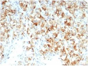 Immunohistochemical analysis of formalin-fixed, paraffin-embedded human kidney carcinoma tissue using Anti-CDC20 Antibody [CDC20/7026R] at 2 µg/ml