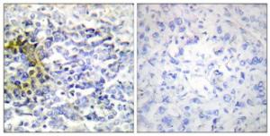 Immunohistochemical analysis of paraffin-embedded human lung carcinoma tissue using Anti-FXR2 Antibody. The right hand panel represents a negative control, where the antibody was pre-incubated with the immunising peptide.