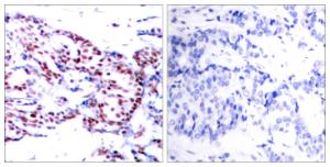 Immunohistochemical analysis of paraffin-embedded human breast carcinoma tissue using Anti-ATF2 Antibody. The right hand panel represents a negative control, where the antibody was pre-incubated with the immunising peptide