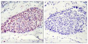 Immunohistochemical analysis of paraffin-embedded human breast carcinoma tissue using Anti-ATF2 Antibody. The right hand panel represents a negative control, where the antibody was pre-incubated with the immunising peptide.