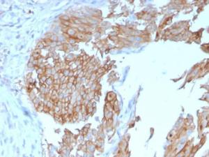 Immunohistochemical analysis of formalin-fixed, paraffin-embedded human urothelial carcinoma using Anti-Uroplakin 1B Antibody [UPK1B/3102]