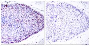 Immunohistochemical analysis of paraffin-embedded human breast carcinoma tissue using Anti-ATF2 Antibody. The right hand panel represents a negative control, where the antibody was pre-incubated with the immunising peptide.