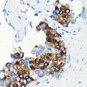 Immunohistochemistry analysis of paraffin-embedded human liver cancer using Anti-C Reactive Protein Antibody [ARC0341] (A309038) at a dilution of 1:100 (40x lens). Perform microwave antigen retrieval with 10 mM PBS buffer pH 7.2 before commencing with IHC staining protocol.