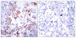 Immunohistochemical analysis of paraffin-embedded human breast carcinoma tissue using Anti-ATF2 Antibody. The right hand panel represents a negative control, where the Antibody was pre-incubated with the immunising peptide