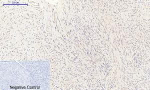 Immunohistochemical analysis of paraffin-embedded human uterus cancer tissue using Anti-eNOS Antibody at 1:200 (4 °C overnight). Negative control was secondary antibody only