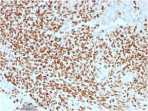 Immunohistochemical analysis of formalin-fixed, paraffin-embedded human Ewing's sarcoma using Anti-NKX2.2 Antibody [NX2/1523]