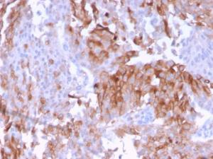 Immunohistochemical analysis of formalin-fixed, paraffin-embedded human urothelial carcinoma using Anti-Uroplakin 1B Antibody [UPK1B/3102]