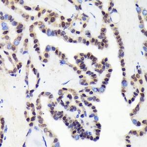 Immunohistochemistry analysis of paraffin-embedded human thyroid cancer using Anti-CDCA5 Antibody [ARC2096] (A306109) at a dilution of 1:100 (40x lens). Perform microwave antigen retrieval with 10 mM Tris/EDTA buffer pH 9.0 before commencing with IHC staining protocol.