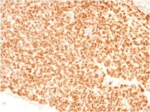 Immunohistochemical analysis of formalin-fixed, paraffin-embedded human Ewing's sarcoma using Anti-NKX2.2 Antibody [NX2/1523]