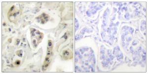 Immunohistochemical analysis of paraffin-embedded human lung carcinoma tissue using Anti-HSP60 Antibody. The right hand panel represents a negative control, where the antibody was pre-incubated with the immunising peptide