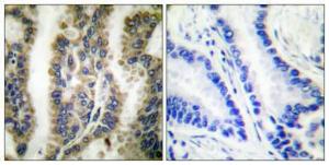 Immunohistochemical analysis of paraffin-embedded human lung cancer using Anti-HSP60 Antibody 1:100 (4 °C overnight). The right hand panel represents a negative control, where the antibody was pre-incubated with the immunising peptide