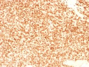 Immunohistochemical analysis of formalin-fixed, paraffin-embedded human Ewing's sarcoma using Anti-NKX2.2 Antibody [NX2/1524]