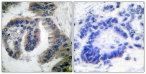 Immunohistochemical analysis of paraffin-embedded human lung carcinoma tissue using Anti-HSP40 Antibody. The right hand panel represents a negative control, where the antibody was pre-incubated with the immunising peptide