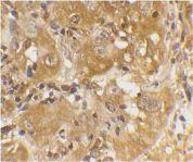 Immunohistochemistry analysis of human skin cancer cells. The Primary Antibody used was Anti-Bim Antibody (A304981) at 1:100.