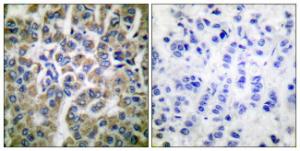 Immunohistochemical analysis of paraffin-embedded human breast carcinoma tissue using Anti-HSP10 Antibody. The right hand panel represents a negative control, where the antibody was pre-incubated with the immunising peptide.